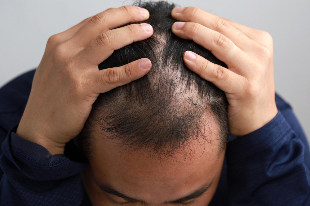 Alopecia da stress o psicogena