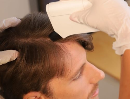 alopecia da stress