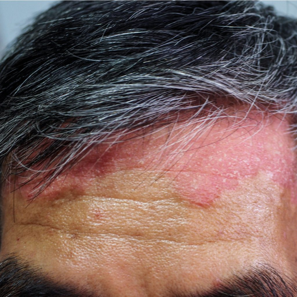 Psoriasi del cuoio capelluto
