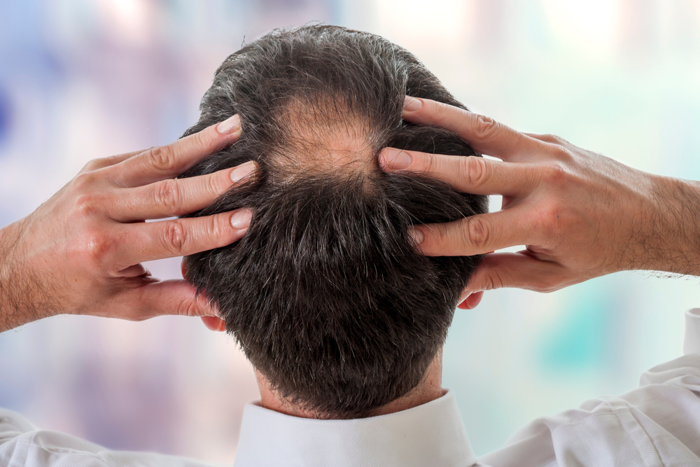 Alopecie post-infettive