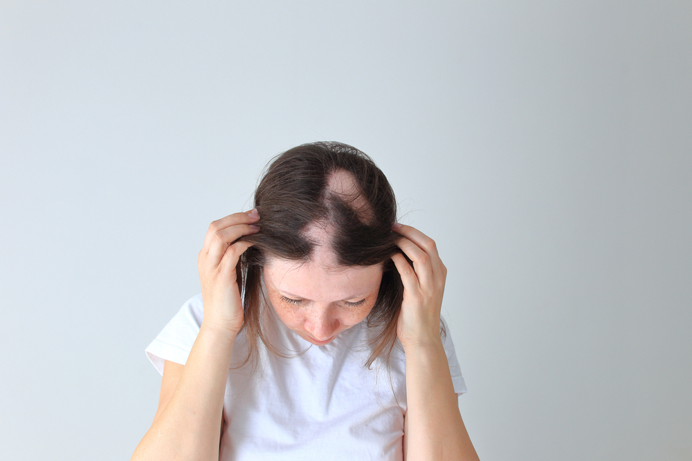 Alopecia da Tricotillomania