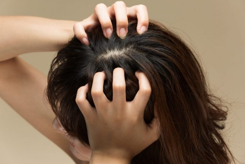 Alopecia Seborroica