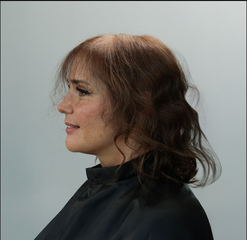 Prima &mdash; GIovanna - Alopecia androgenetica
