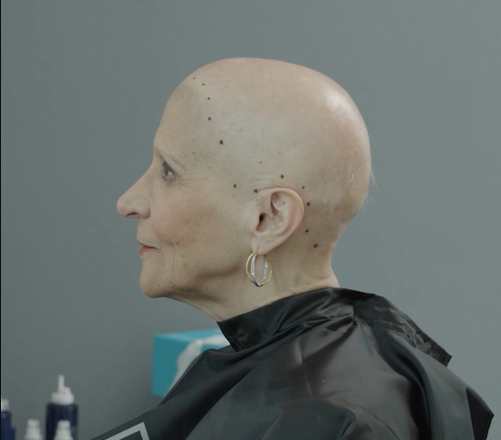 Prima &mdash; Silvia - Alopecia indotta da chemioterapia
