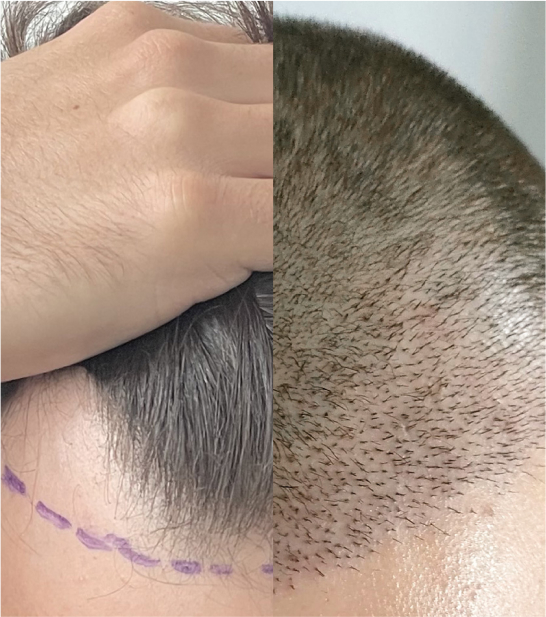 CRLAB HAIR TRANSPLANT 