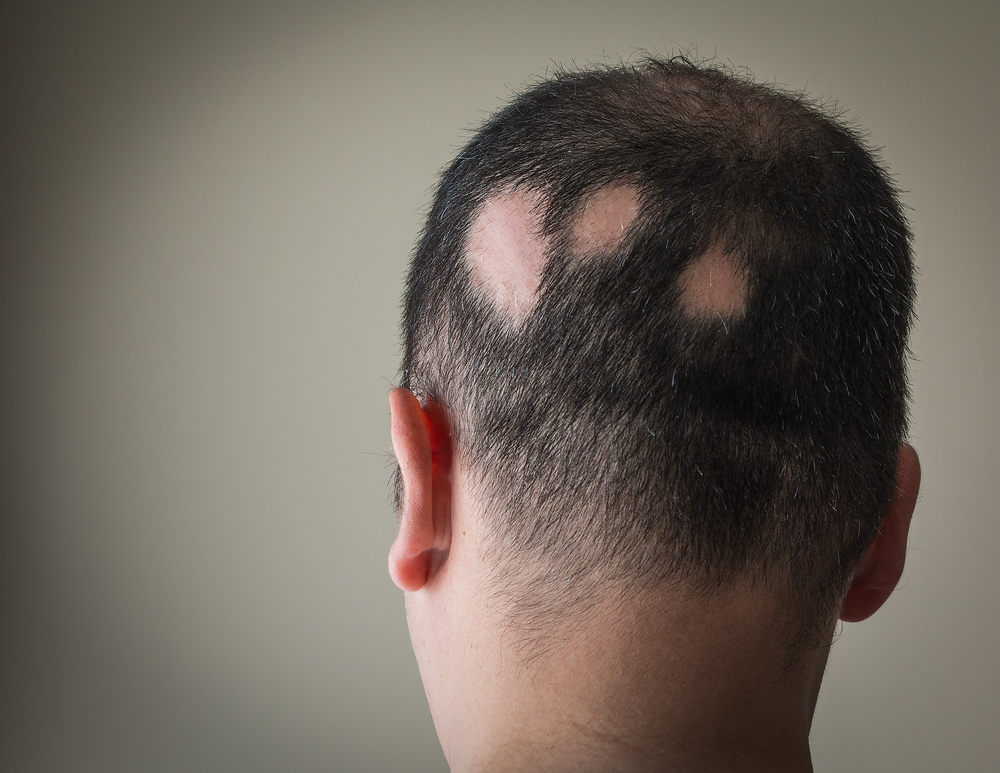 Alopecia areata: cause, sintomi e rimedi efficaci