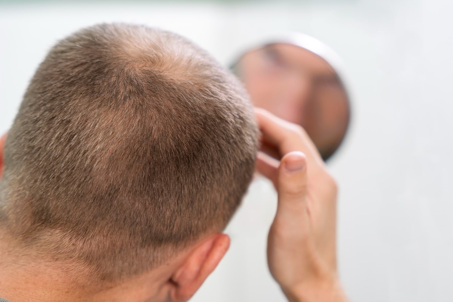 Alopecia Androgenetica: caratteristiche, cause e rimedi