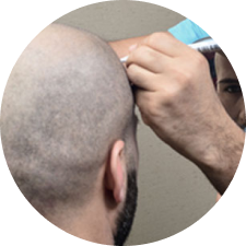  Hair transplant surgery
