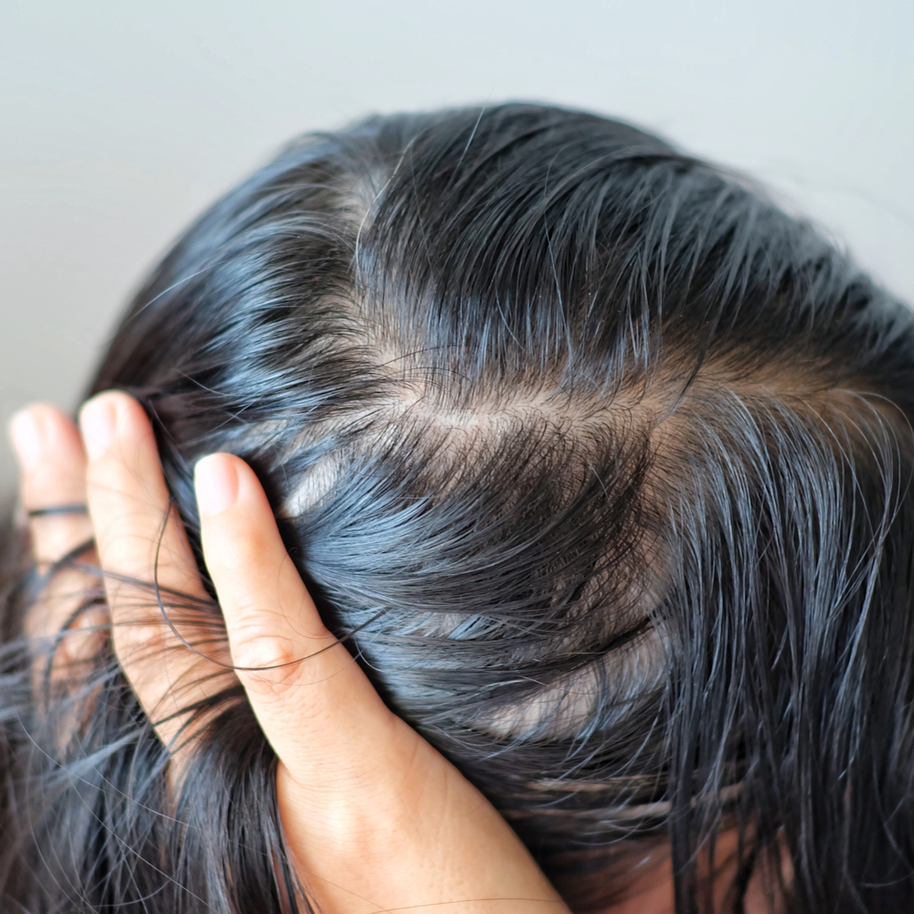 Cuoio Capelluto Grasso