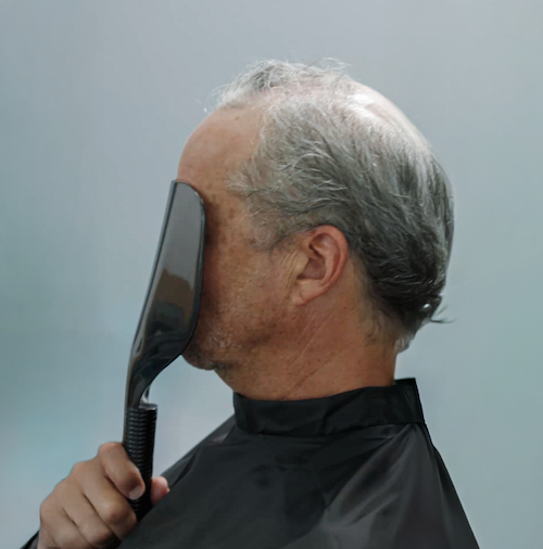 Prima &mdash; Alessio - Alopecia androgenetica