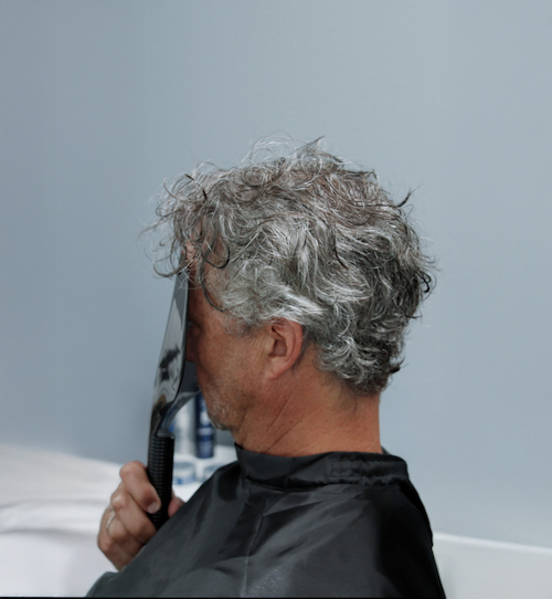 Dopo &mdash; Alessio - Alopecia androgenetica