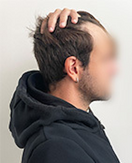 Prima &mdash; Lorenzo - Alopecia androgenetica