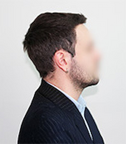 Dopo &mdash; Lorenzo - Alopecia androgenetica