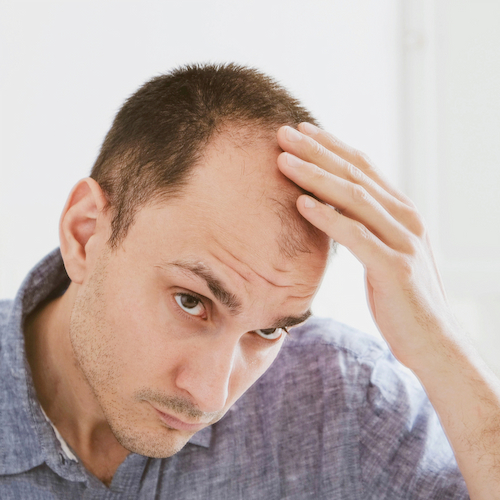 Alopecia androgenetica o calvizie