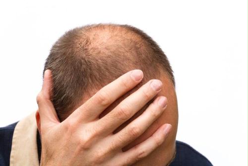 Caduta capelli: manifestazione, cause e prevenzione