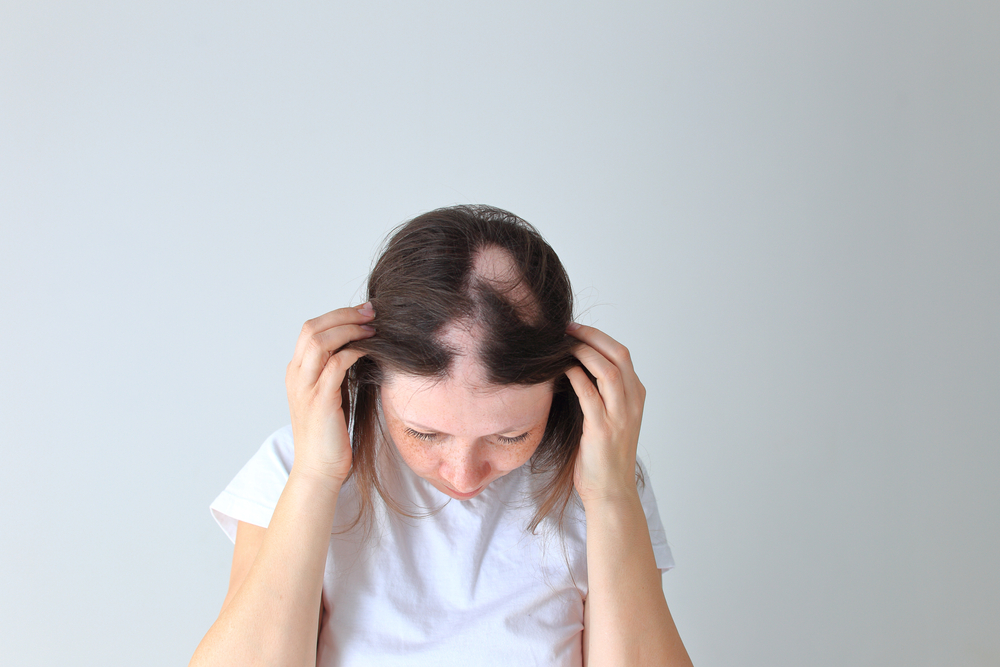 Alopecia da Tricotillomania CRLAB